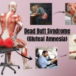 Dead Butt Syndrome