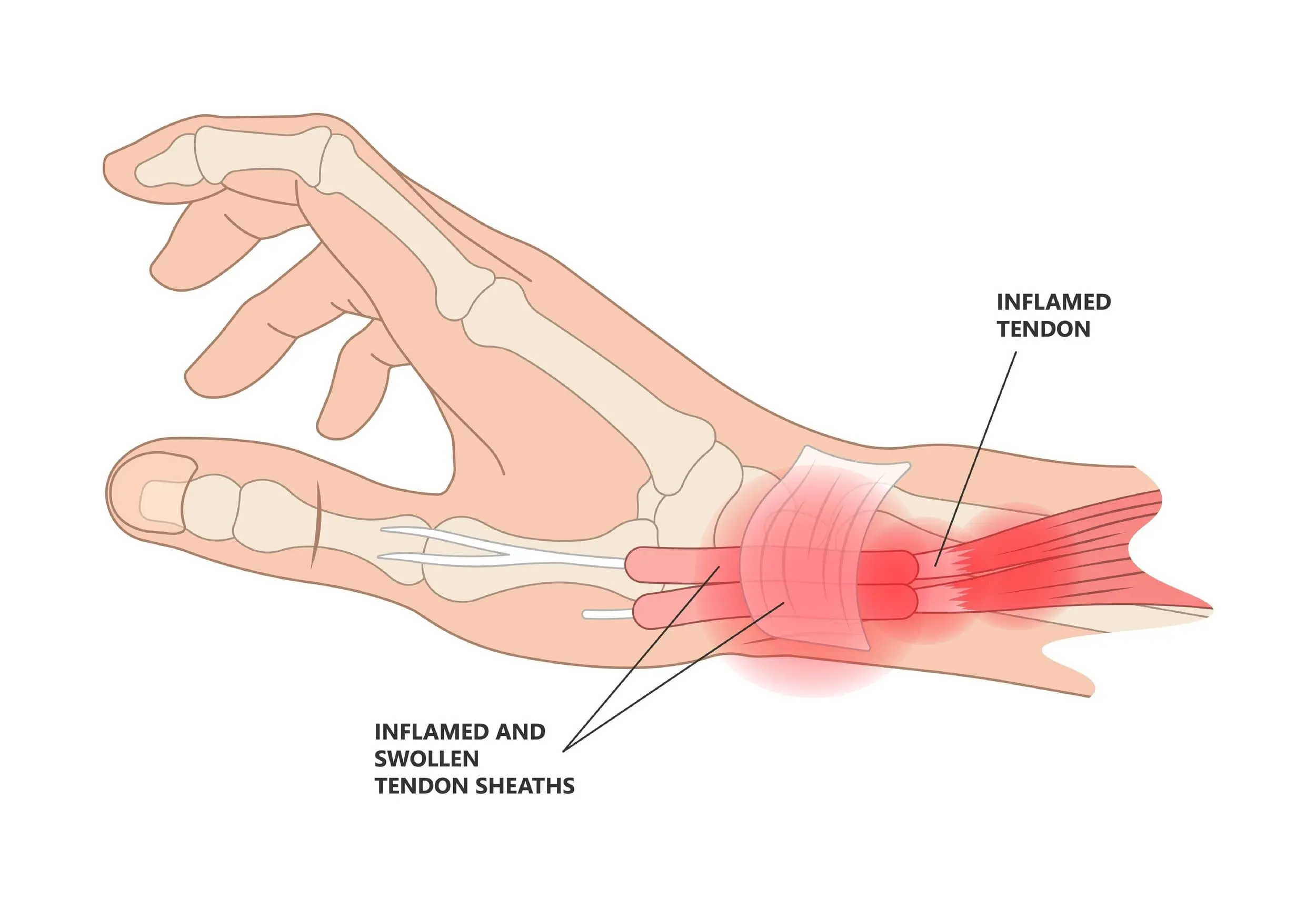 De Quervain's Tenosynovitis