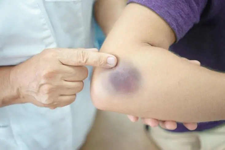 Fractures-and-Contusions