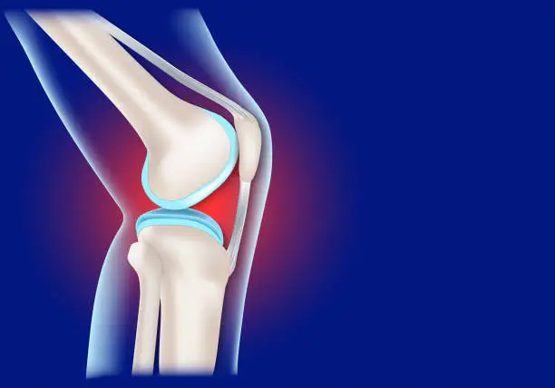 Patellar-Tendinopathy