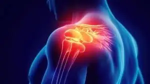 Shoulder Impingement