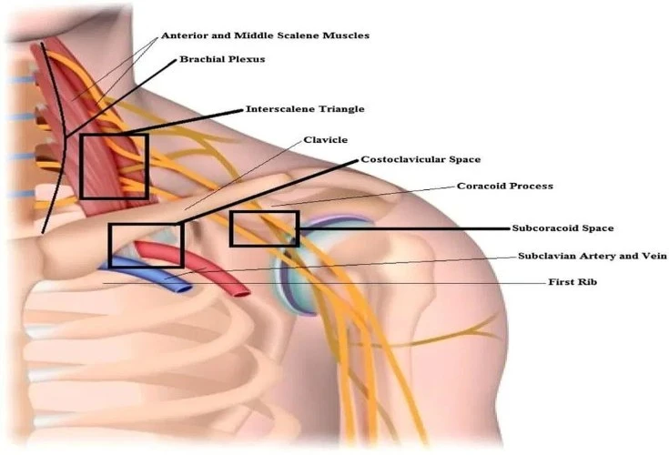 Thoracic Outlet Syndrome