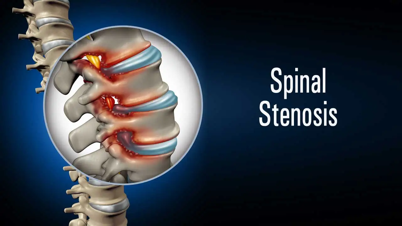 Spinal Stenosis