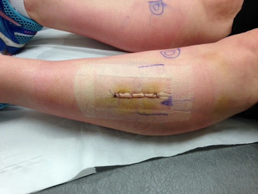 Chronic Exertional Compartment Syndrome