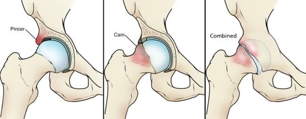 Femoroacetabular Impingement