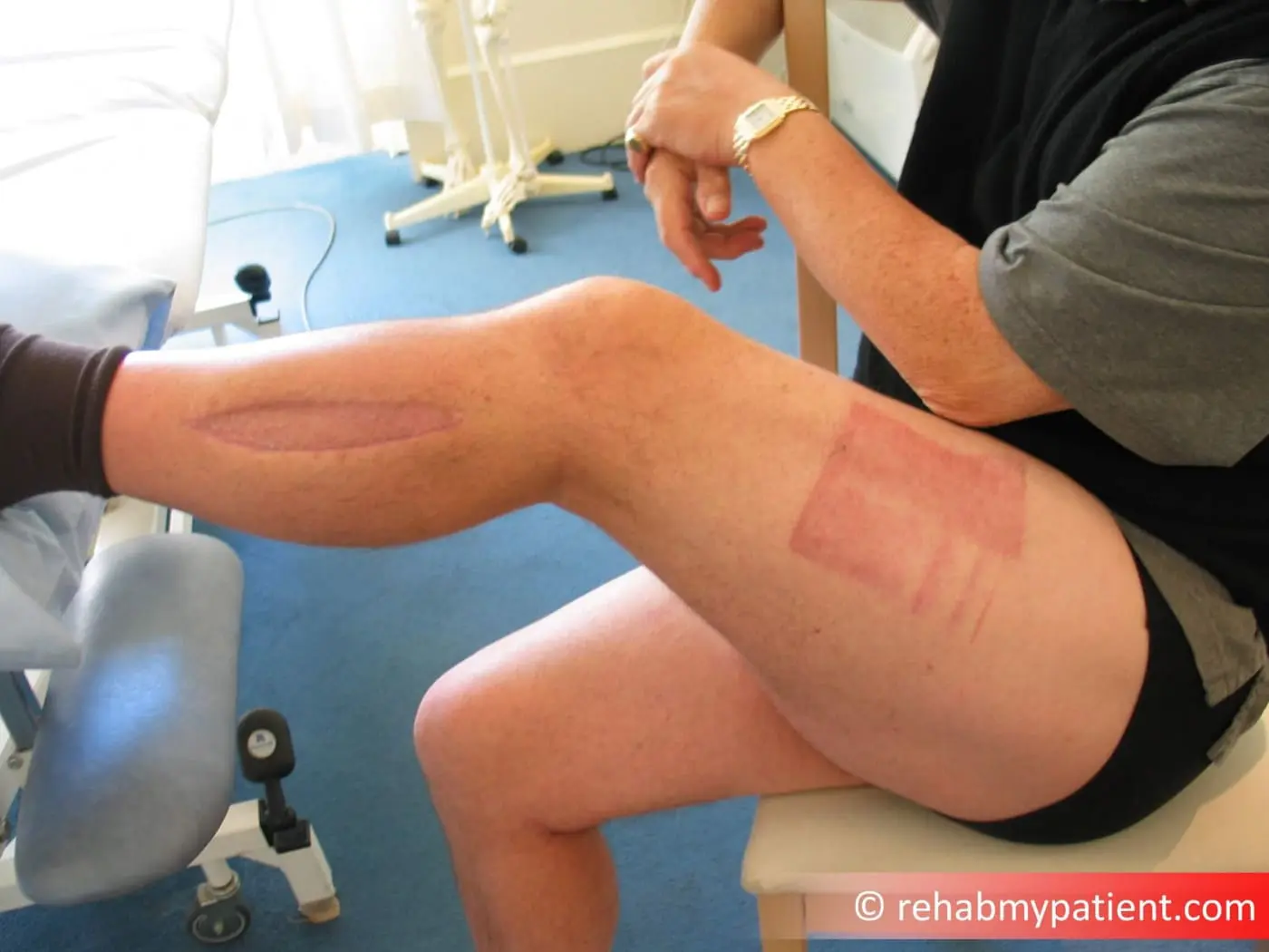 Compartment Syndrome