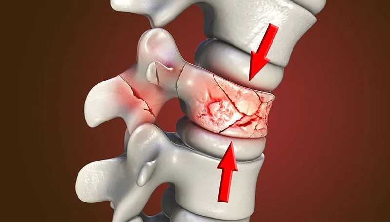 vertebral compression fracture