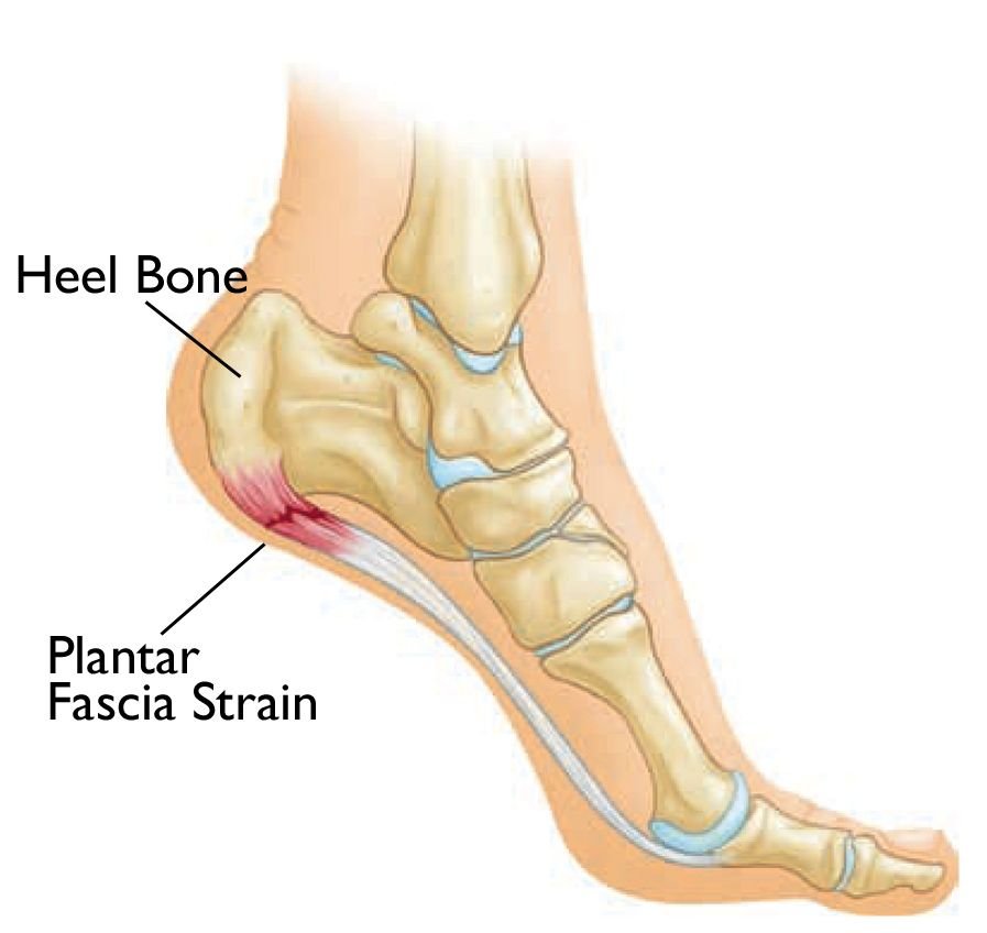 Heel Spur