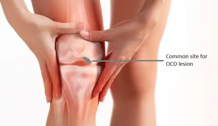 Osteochondritis Dissecans