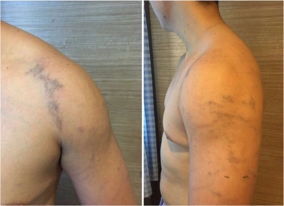 Paget-Schroetter Syndrome