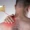 Parsonage-Turner Syndrome