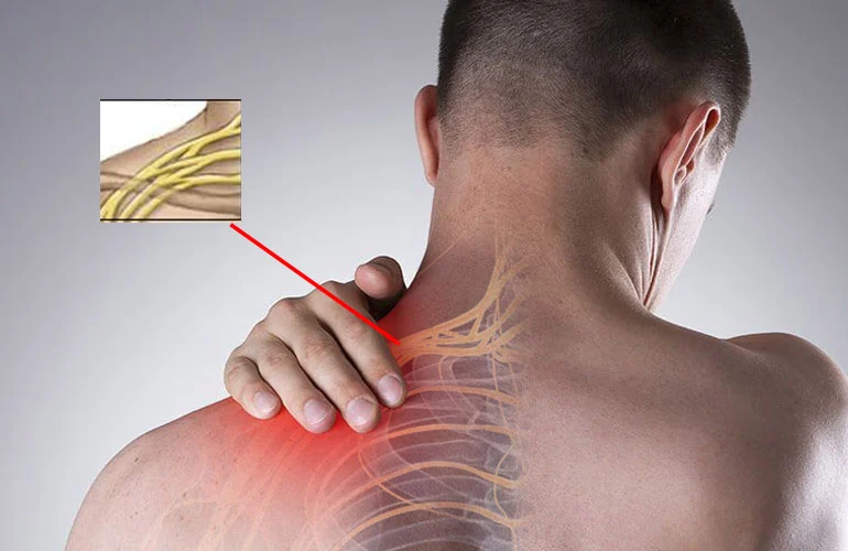 Parsonage-Turner Syndrome