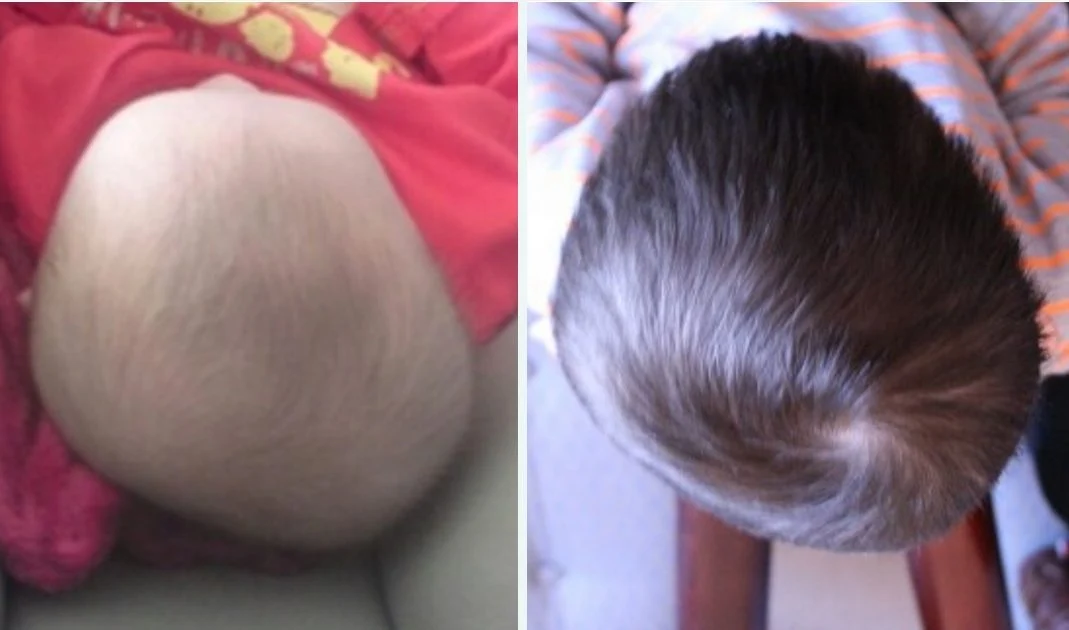 Plagiocephaly