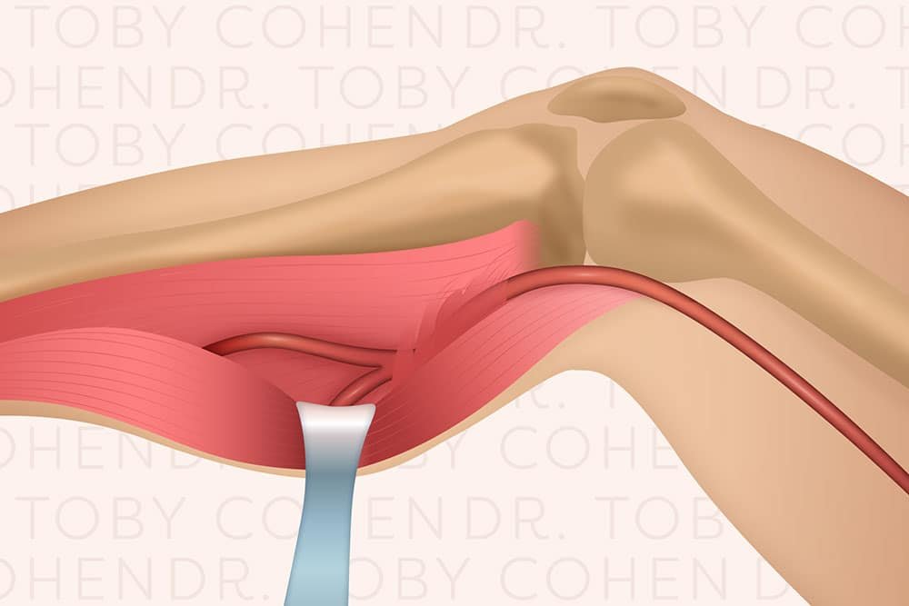 Popliteal Artery Entrapment Syndrome