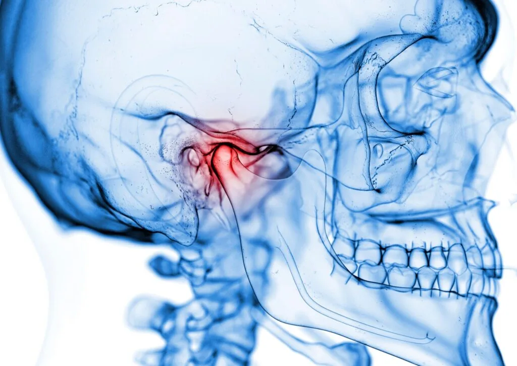 Temporomandibular Joint Dysfunction