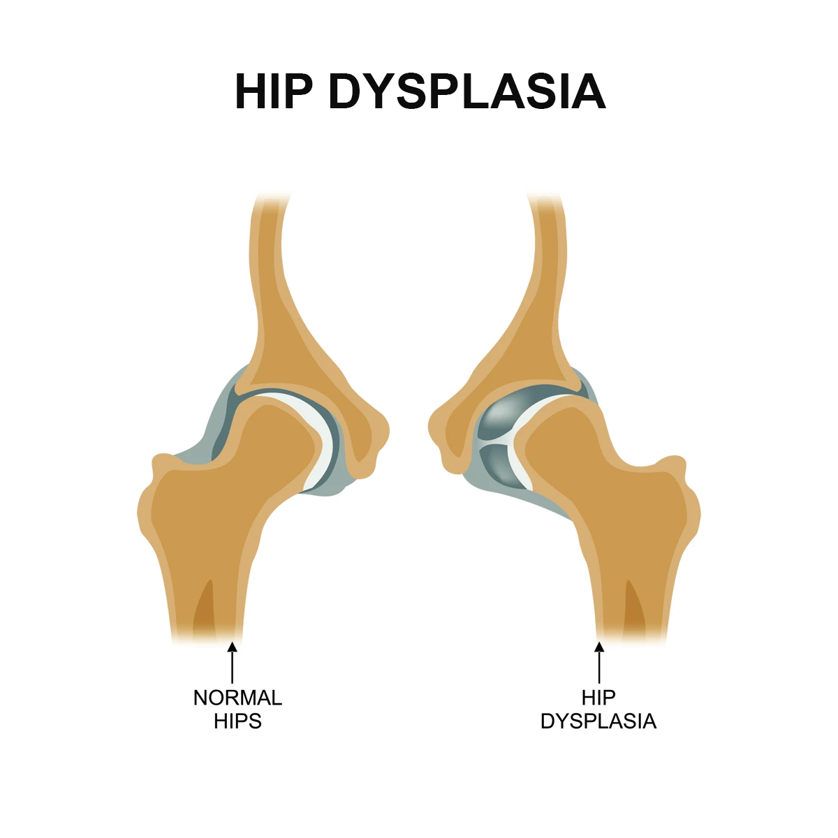 Congenital Dysplasia of Hip