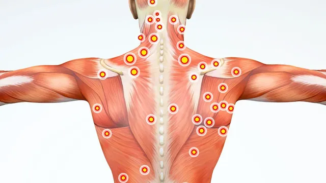 Myofascial Pain Syndrome