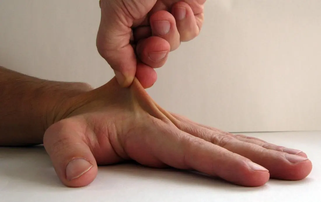 Ehlers-Danlos Syndrome