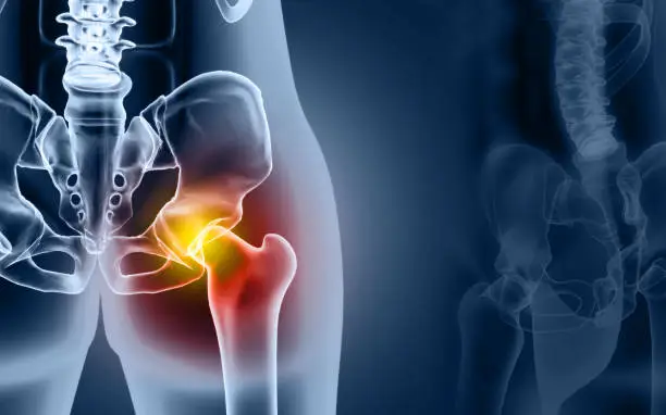 Hip Arthritis