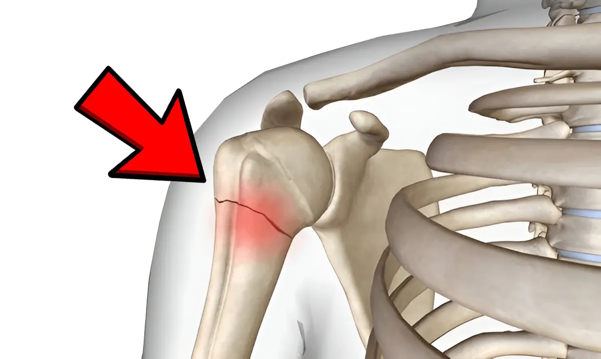 Post Humerus Fracture
