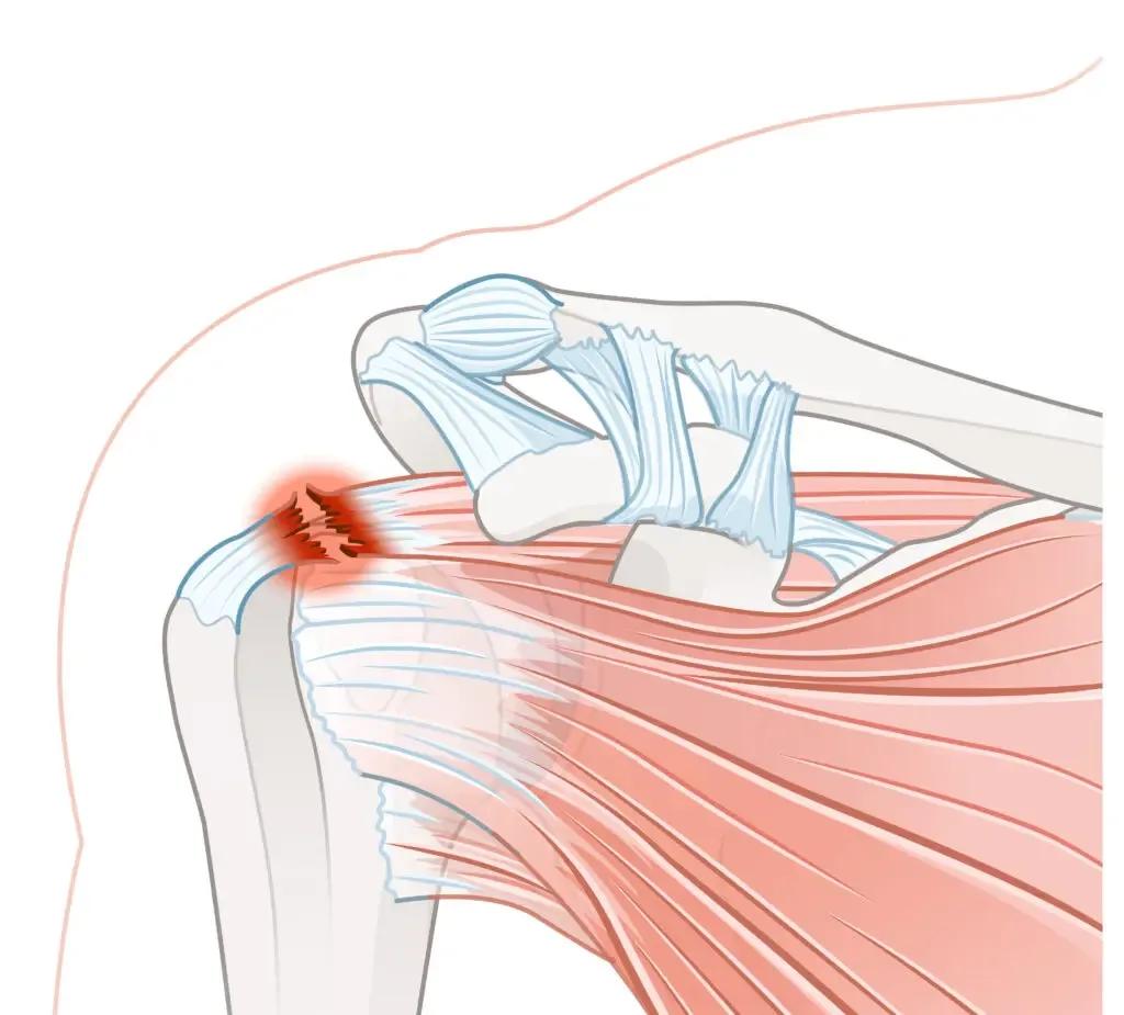 Supraspinatus Injury