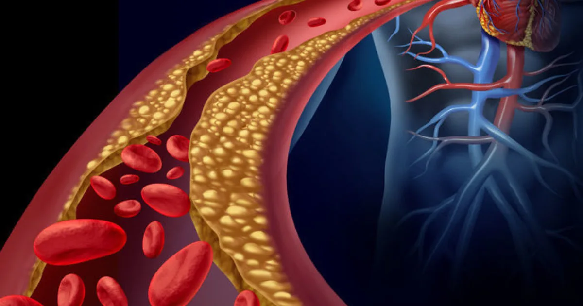 atherosclerosis