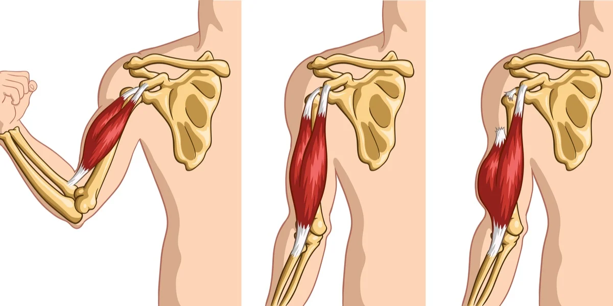 Biceps Tendon Rupture