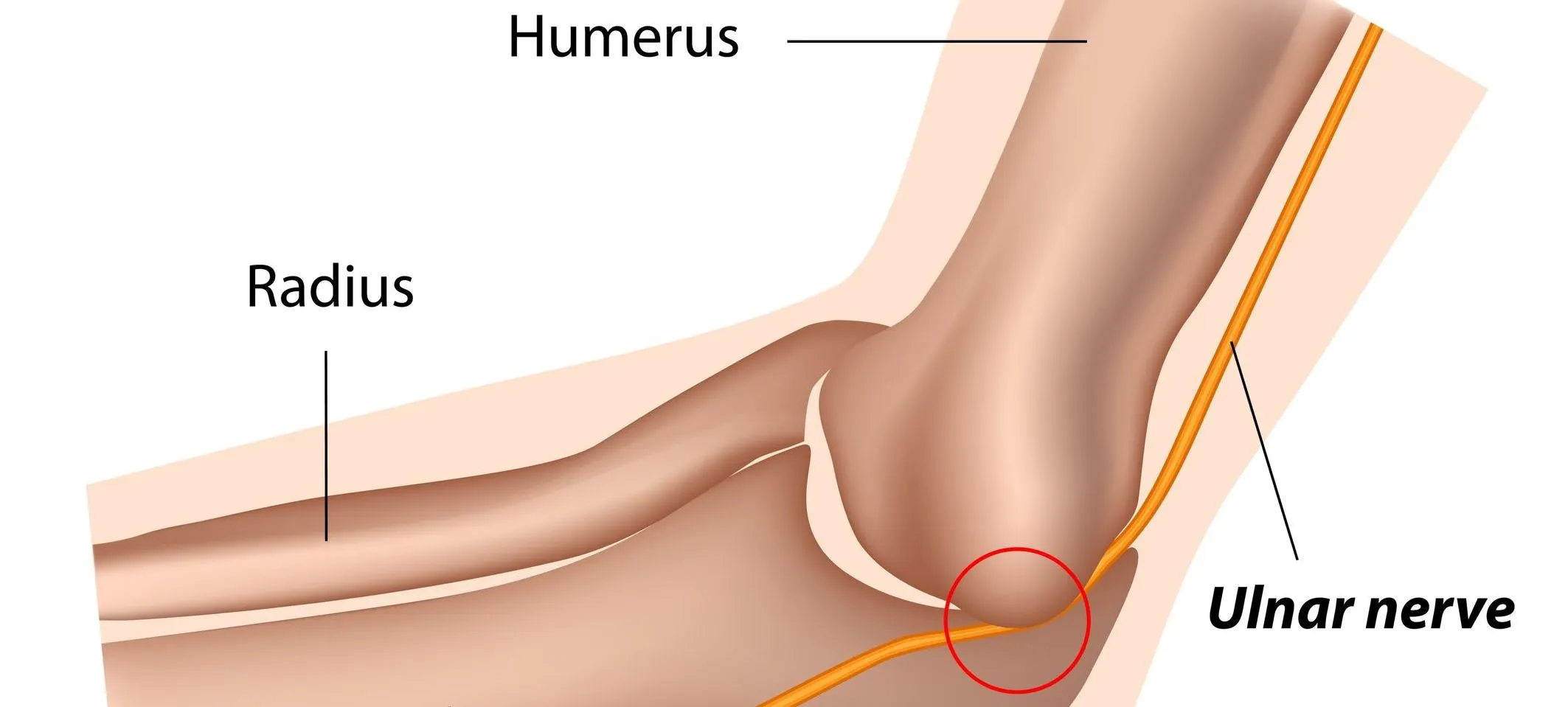 Ulnar Nerve Impingement
