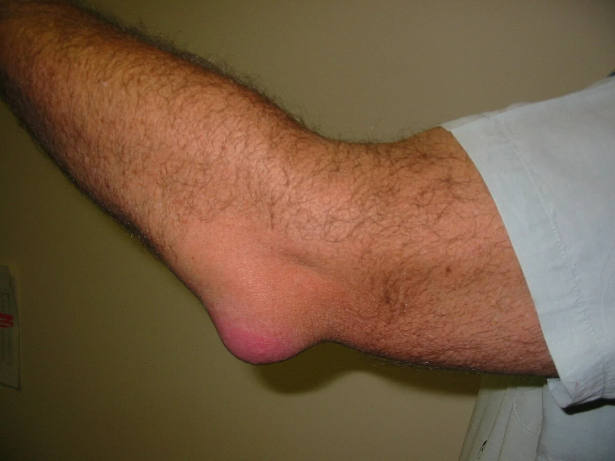 Olecranon bursitis