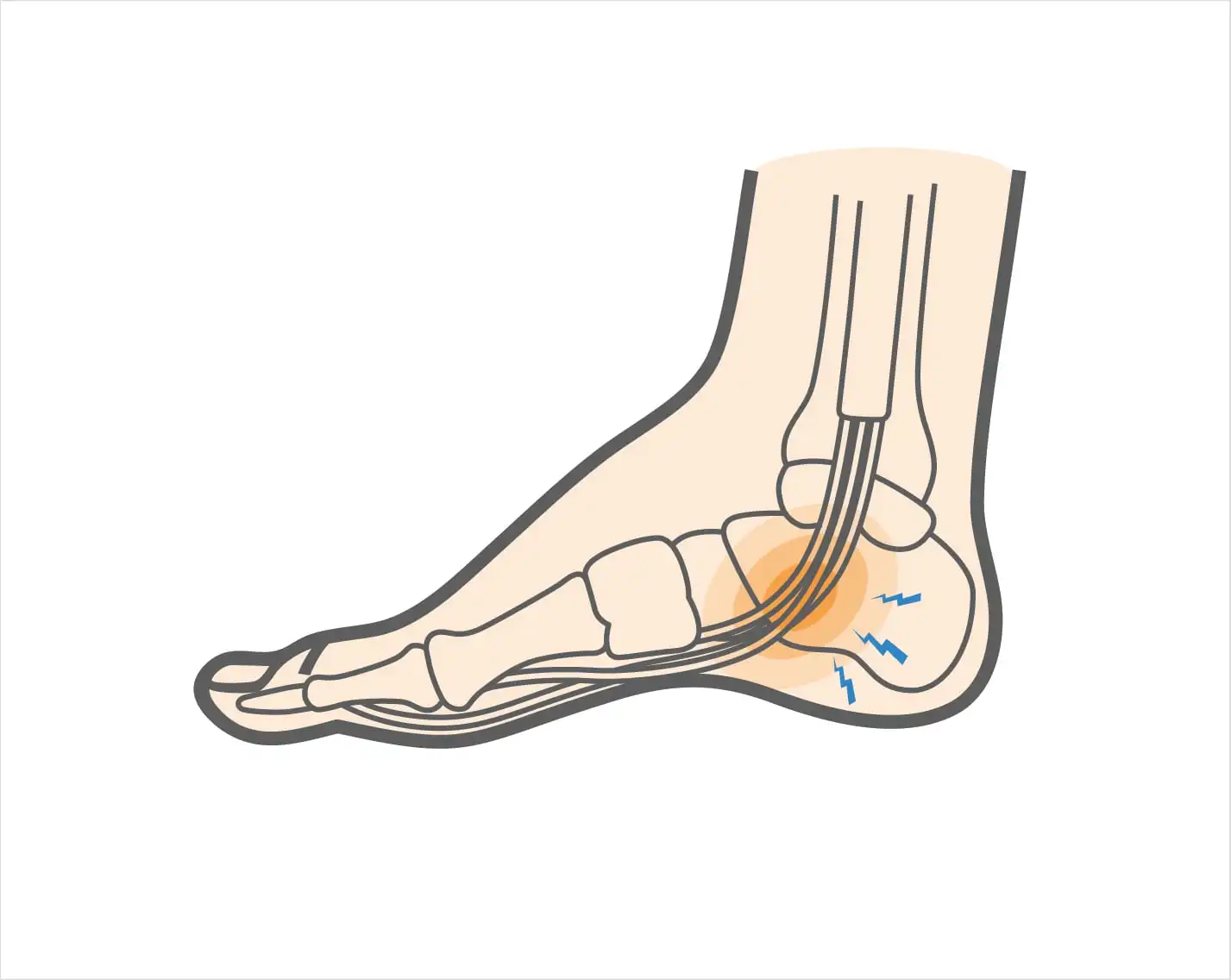 Flexor Hallucis Longus Tendinitis Injury