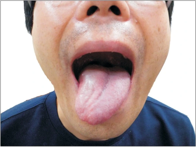 Hypoglossal Nerve Injury