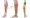 Soleus Strain