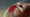 Subdeltoid Bursitis