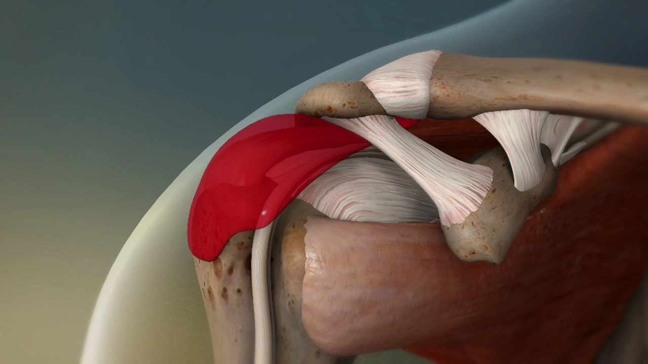 Subdeltoid Bursitis