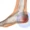 Subtendinous Achilles Bursitis