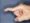 Swan Neck Deformity