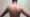 Thoracodorsal Nerve Injury