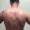 Thoracodorsal Nerve Injury