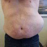 Subcostal Nerve Injury