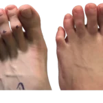 Hammer Toe