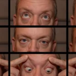 Trochlear Nerve Injury