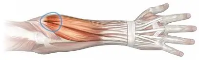 Forearm Extensor Strain