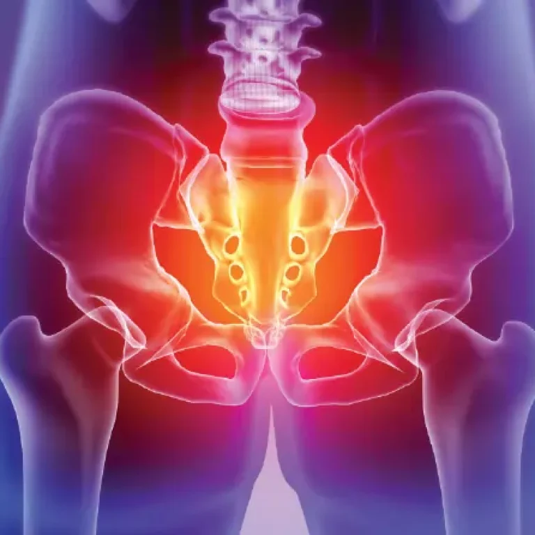 Chronic Pelvic Pain