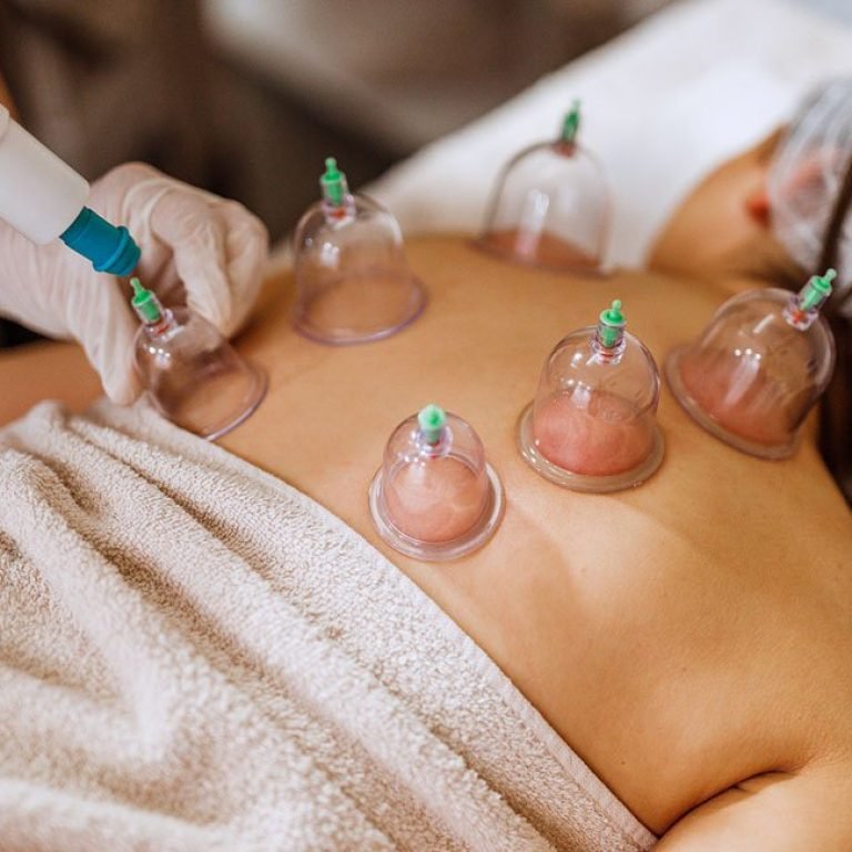 Functional Cupping